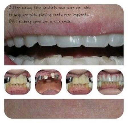 la mesa denture and implants before and after
