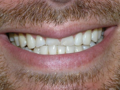 Full Mouth Reconstruction Gallery Before & After Image